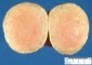 Subserosal uterine leiomyoma