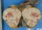 Seminoma of the testis