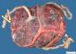Triple pregnancy placenta