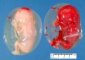 Twin-twin transfusion syndrome