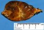 Adrenal pheochromocytoma