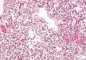 Hyaline membrane disease
