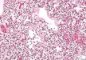 Hyaline membrane disease