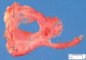 Bilateral diaphragmatic hernia in malformative syndrome