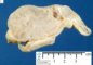 Enchondroma in Maffucci syndrome