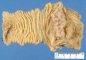 Gastric heterotopia in small intestine