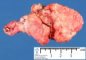 Sacrococcygeal teratoma (Macroscopy)