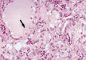 C-cell hyperplasia with microscopic medullary thyroid carcinoma (...)