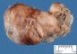 Nasal juvenile angiofibroma