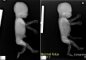 Femoral bowing in osteogenesis imperfecta (21 weeks) with normal (...)