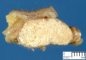 Pilomatrixoma