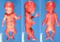 Short rib-polydactyly syndrome