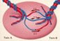 Twin-twin transfusion - Figure
