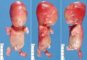 MIcromelia in non otherwise specified syndrome (Etiology unknown)
