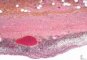 Local peritonitis in acute appendicitis