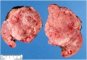 Suprarenal neuroblastoma