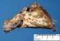 Bronchiectasis and BALT hyperplasia (Case 11750)