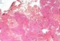 Plexiform schwannoma