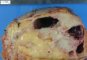 Caliceal urothelial carcinoma with pyonephrosis