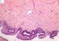 Biliary epithelial dysplasia in choledochal cyst
