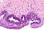 Biliary epithelial dysplasia in choledochal cyst