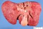 Micronodular cirrhosis in Wilson disease