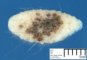 Congenital melanocytic nevus