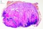 Pilomatricoma