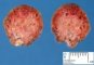 Rectal juvenile polyp