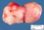 Thyroid teratoma