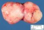Thyroid teratoma