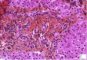 Portal fibrosis and biliary ductular proliferation in juvenile (...)