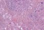 Nodal cryptococcosis (Cryptococcus neoformans)