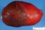 Hepatoblastoma