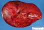 Hepatoblastoma