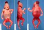 Posterior encephalocele in meckel syndrome