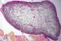 Botryoid embryonal rhabdomyosarcoma of the rhinopharynx