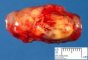 Cellular schwannoma