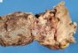 Crohn ileitis