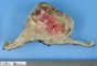cystic renal malignant rhabdoid tumor