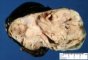 Intra-abdominal immature teratoma