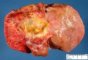 Kasai procedure in extra-hepatic biliary tract atresia