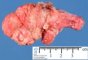 Sacrococcygeal teratoma (Macroscopy)