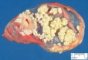 Ovarian mature teratoma (dermoid cyst)