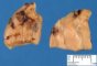 Parathyroid adenoma