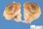Testicular necrosis in cryptorchidism