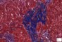 Portal fibrosis and biliary ductular proliferation in juvenile (...)