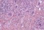 Nodal cryptococcosis (Cryptococcus neoformans)