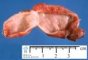 Mediastinal esophageal duplication cyst (primitive foregut cyst)