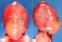 Dolichocephaly in omphalocele-spina bifida association (18 weeks)